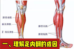 偏瘫后足内翻与走路困难的挑战-专业康复师的指导