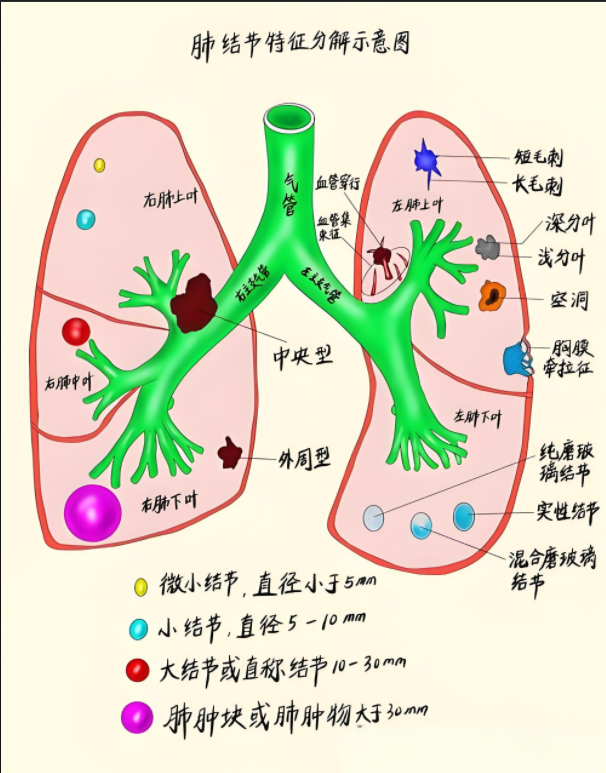 中医巧解肺结节：溯源固本，消结有方