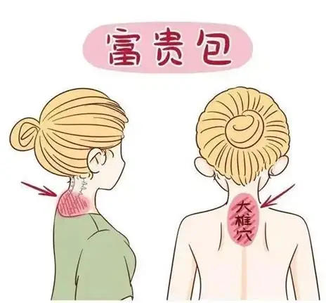 临沂永辉医院：中西医结合，精准攻克富贵包