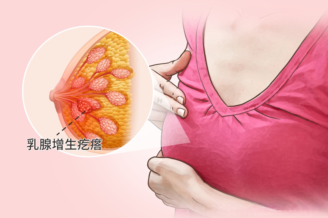 乳腺增生是被气出来的吗？